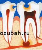 Пульпит зуба - симптомы лечение фото